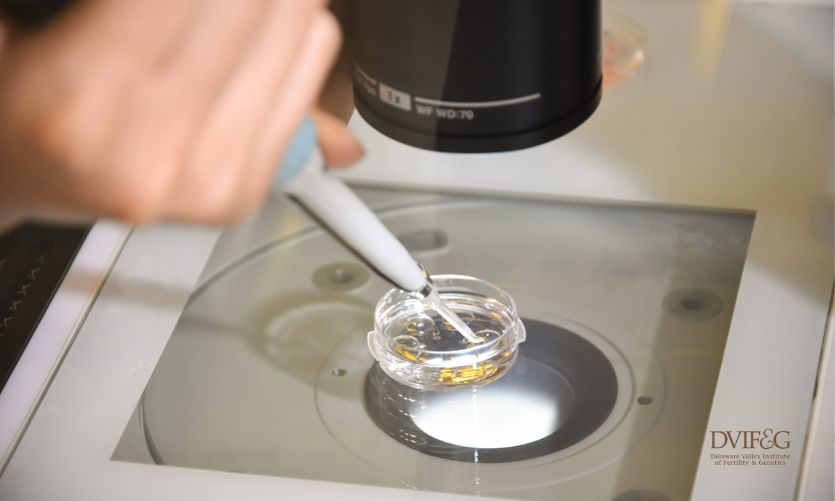 Although fresh embryo transfer (ET) is the norm during assisted reproductive therapies (ART), in the past few years avoiding a fresh embryo transfer and instead freezing all the good quality embryos has emerged as an alternative strategy during in vitro fertilization (IVF) cycles (Roque, 2015). The success of IVF depends not only on embryo quality, but also on the interaction between the embryo and the endometrium, the implantation. During IVF cycles, there are several concerns about the possible adverse effect of the controlled ovarian stimulation (COS) and the high estradiol (E2) levels on the endometrium, which in turn might have an effect on the pregnancy rates (Shapiro et al., 2011; Roque et al., 2013). It is postulated that during the freeze-all strategy, the cryopreserved embryos are transferred later when the E2 is at physiologic levels and the endometrium present a physiologic environment. (Roque, 2015). By performing delayed frozen-thawed ET (FET), any adverse effects of COS over the endometrium is thus avoided, and this should lead to better outcomes (Shapiro et al., 2011, Roque et al., 2013; Roque, 2015). Current perspective of the available literature regarding this subject is that the freeze-all strategy is not designed for all IVF patients. At least two studies show that only patents with polycystic ovary syndrome (PCOS) might be benefited (Chen et al., 2016; Shi et al., 2014). Today, it is reasonable to perform elective cryopreservation of all embryos in cases with a high risk of OHSS development, and in patient with supra-physiologic hormonal levels during the follicular phase of COS. It is not clear if all the patients that had a normal response and poor responders to COS may benefit from this strategy (Roque et al., 2017). We questioned this premise at DVIF&G by analyzing our own data from the last three years and we compare the implantation rates between the fresh and the frozen embryo transfers. The implantation rates were favorable and increased during frozen embryo transfers when compared to fresh embryo transfers. The combined data from 2017 and 2018 showed that the frozen implantation rates almost double by comparison to those in a fresh embryo transfer and in 2019 the frozen embryo implantation rates more than double those of fresh, achieving a high 60% rate. It follows that an increase in implantation rates will lead to a decrease in the average number of embryos transferred. Indeed the average number of embryos transferred in frozen cycles has decreased from 1.5 in years 2017+2018 to an average number of 1.1 embryos in 2019. Whereas, the average numbers of embryos transferred in fresh cycles were higher approximating 2 embryos per transfer than in FET. In the light of these results, our patients are advised to proceed with a freeze all cycles in the hope that their goal will be achieved faster and at the same time minimizing the disappointment from a failed embryo transfer